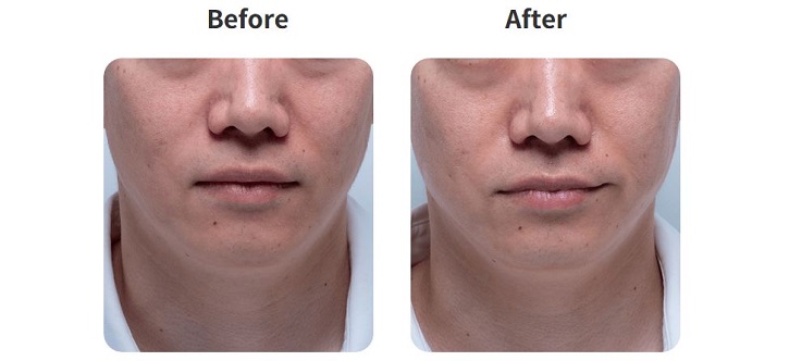 ゴリラクリニック銀座アネックス院について